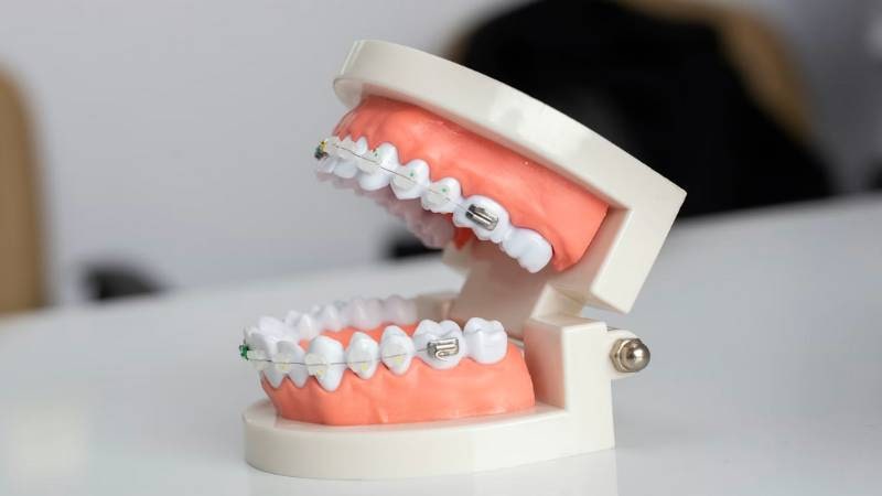 does medicaid cover braces 1